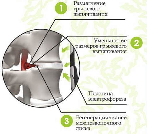 Грыжа межпозвоночного диска: лечение Карипазимом