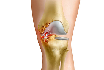 Методы лечения воспалительных заболеваний коленных суставов