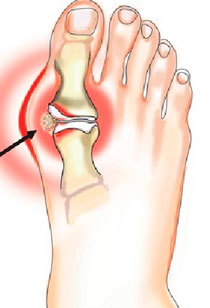 Причины болей в косточках на больших пальцах ног