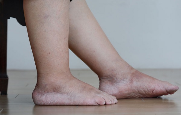Как можно избавиться от косточки на ноге с помощью народной медицины