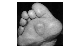 Устранение шишек в области больших пальцев ног