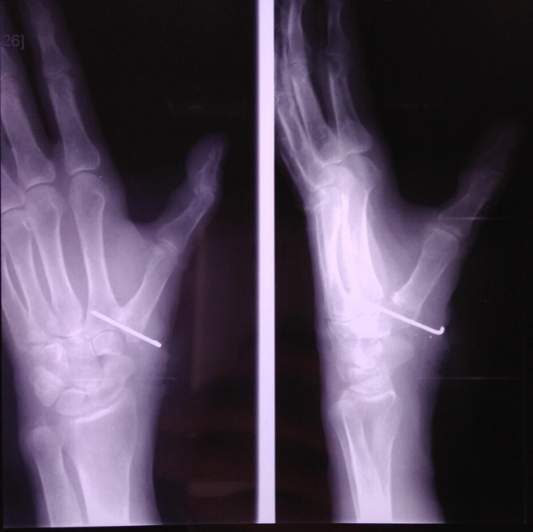Массаж при нарушении строения кости большого пальца