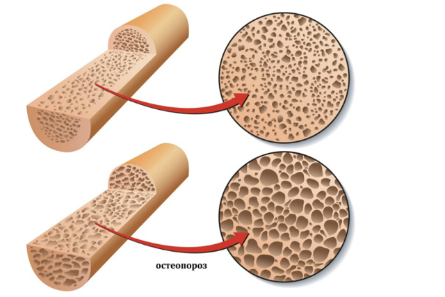 Развитие остеопороза при климаксе