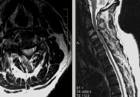 Почему может возникать рассеянный склероз в шейном отделе позвоночного столба?