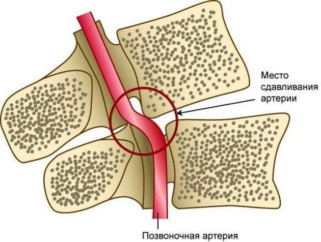Синдром позвоночной артерии при шейном остеохондрозе