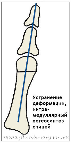 Ортопедическая шина в борьбе с косточками на ногах