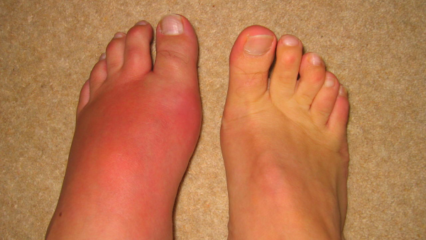 Hallux Valgus – болезнь косточек на ногах