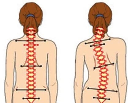 Особенности техники массажа при остеохондрозе