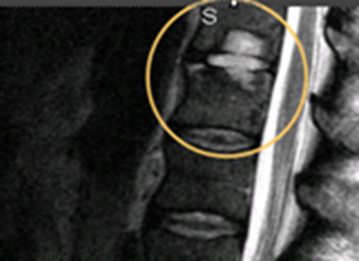 Почему может возникать рассеянный склероз в шейном отделе позвоночного столба?