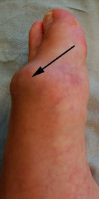 Причины болей в косточках на больших пальцах ног