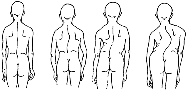 Заболевания позвоночника: смещение грудного отдела (сколиоз)