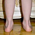 Вальгус на женских ногах