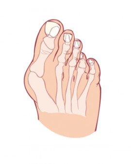 Устранение шишек в области больших пальцев ног