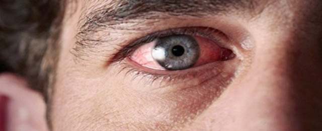 Лечение глаз после сварки в домашних условиях