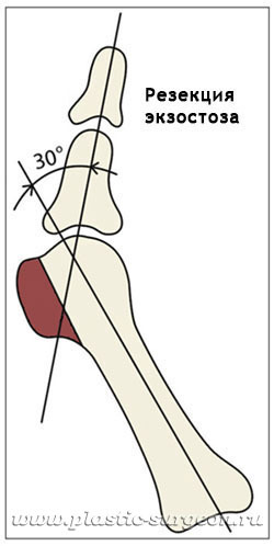 Ортопедическая шина в борьбе с косточками на ногах